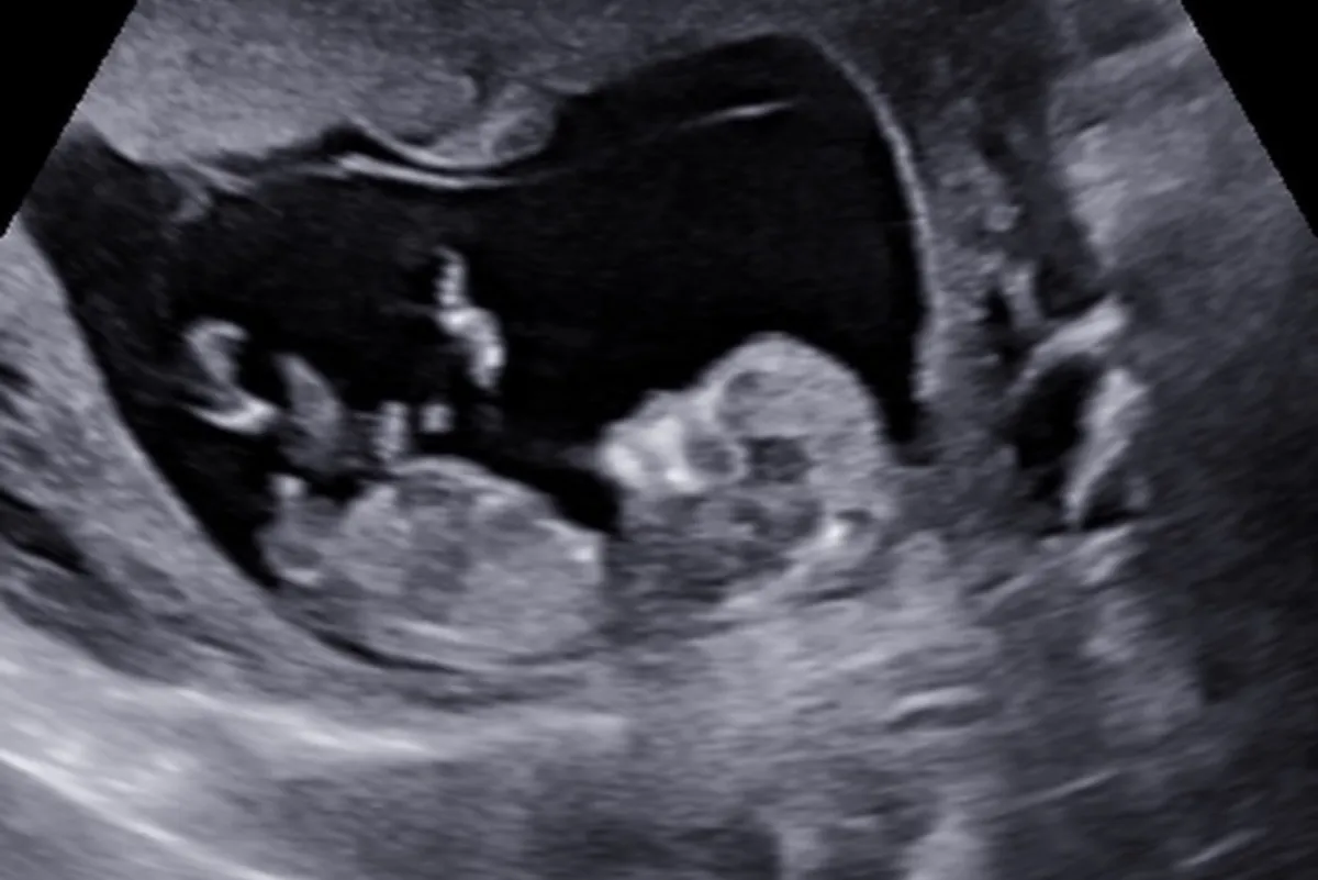 Fetal ultrasound showing a side profile of the developing fetus inside the uterus.